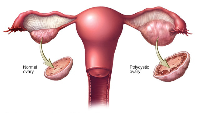 PCOS 2
